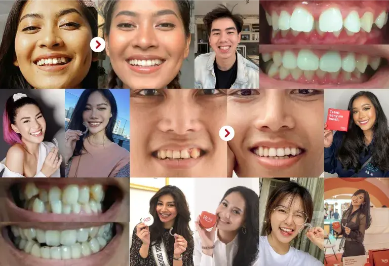 clear aligners Indonesia