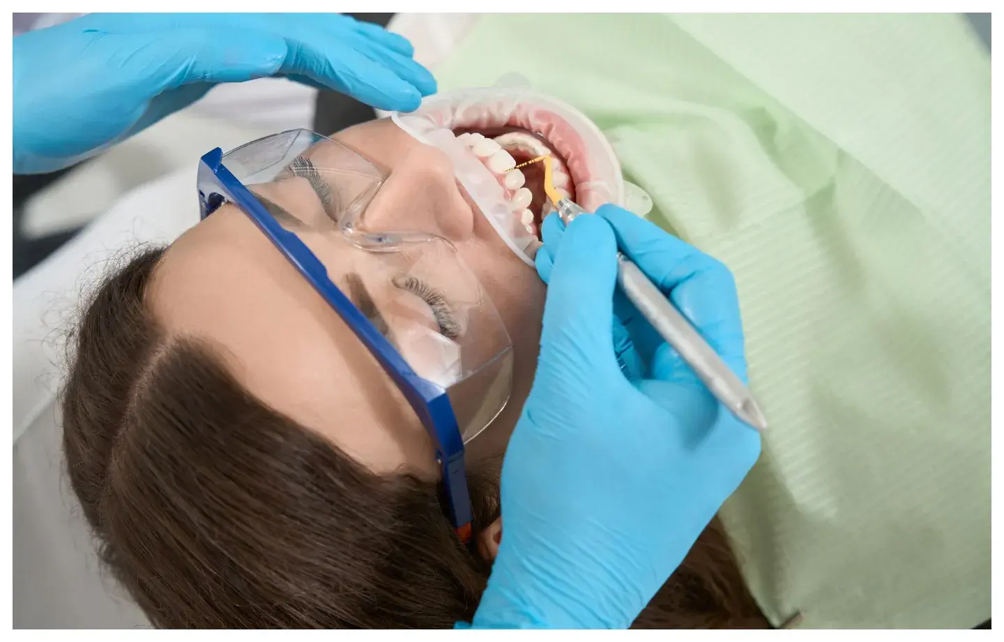 definisi scaling gigi, kapan harus dilakukan, cara dan durasi scaling gigi