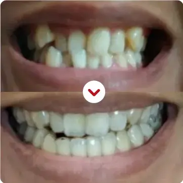 review rata.id before after clear aligners
