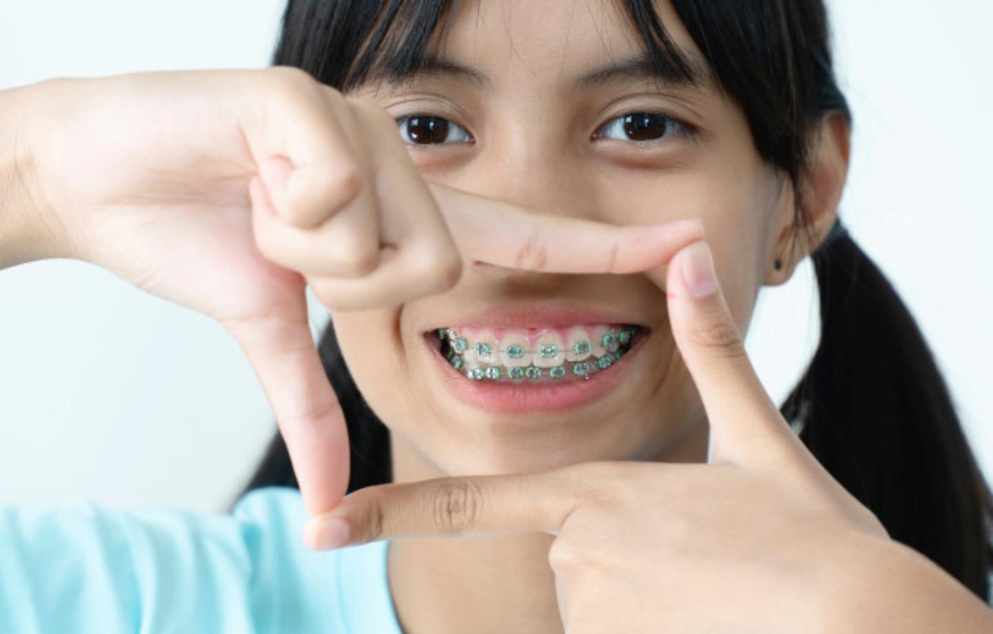 Kapan Umur yang Tepat untuk Memakai Kawat Gigi Anak? Ini Faktanya