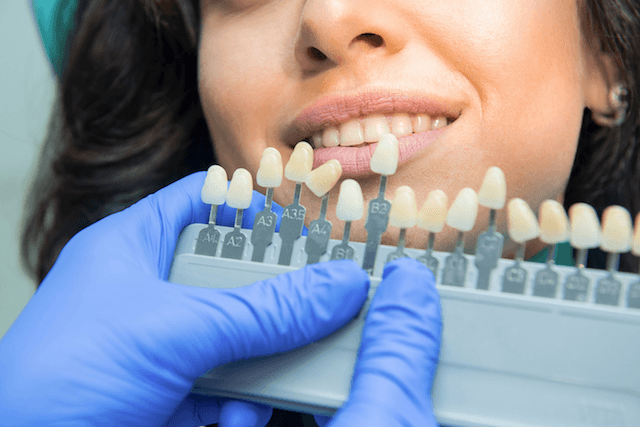 berapa kisaran biaya memutihkan gigi dan harga bleaching gigi di Indonesia