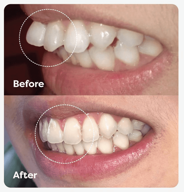 review rata.id before after clear aligners